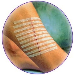 Sutures cutanées adhésives stériles 3M™ Steri-Strip™*
